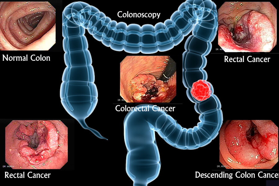 Colorectal Adenocarcinoma