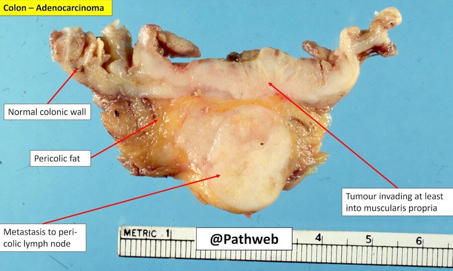 Colorectal Adenocarcinoma
