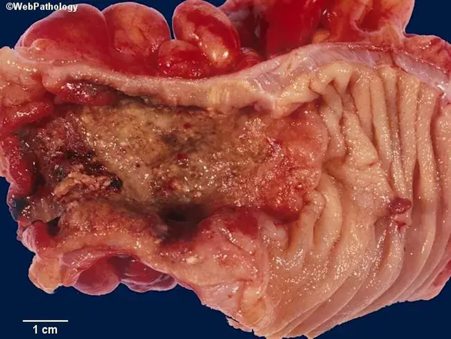 Colorectal Adenocarcinoma