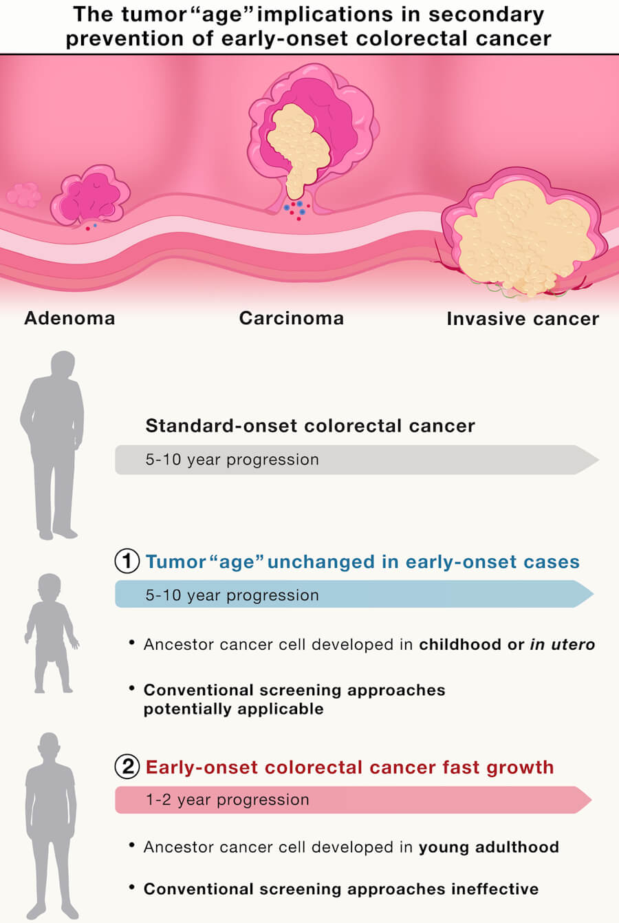 Colorectal Adenocarcinoma