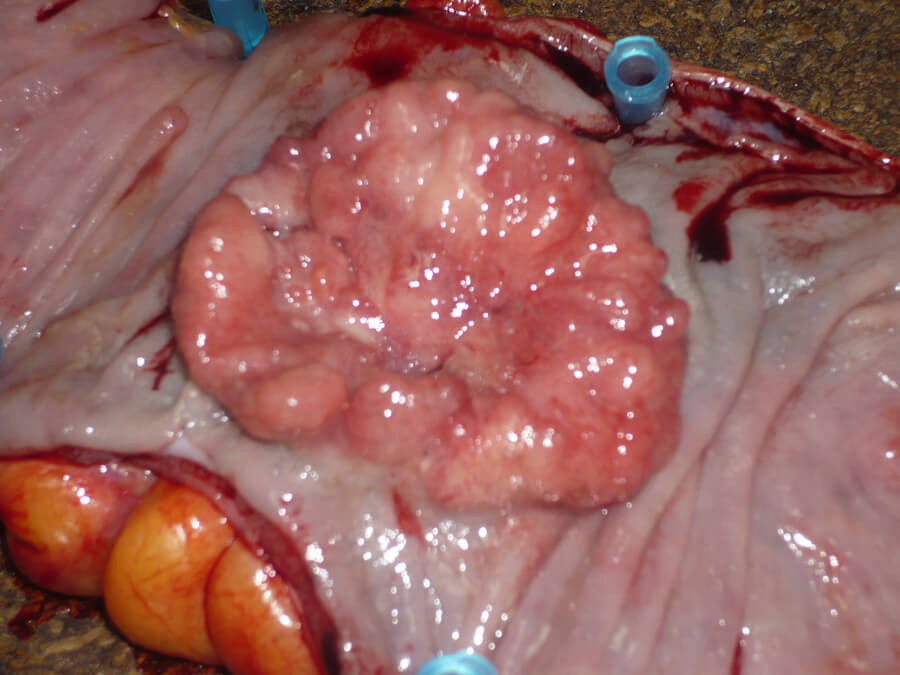 Colorectal Adenocarcinoma