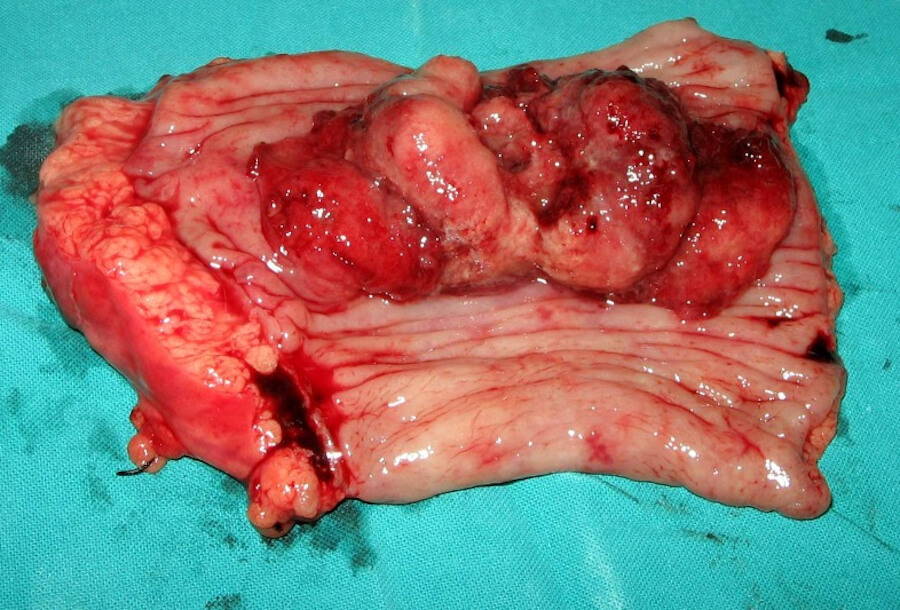 Colorectal Adenocarcinoma