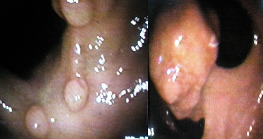 Colorectal Adenocarcinoma