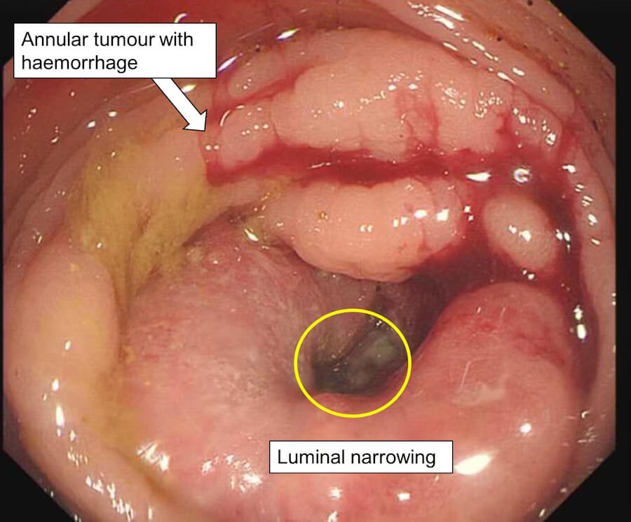 Colorectal Adenocarcinoma