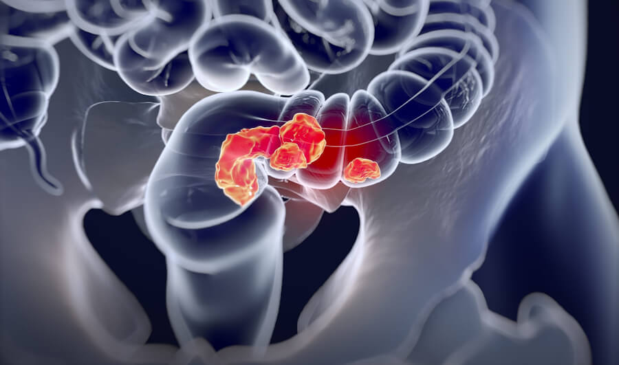 Colorectal Adenocarcinoma