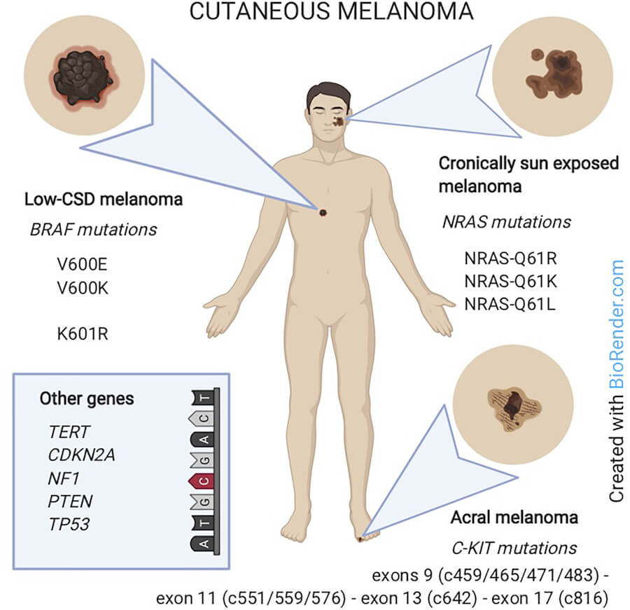 Cutaneous Melanoma
