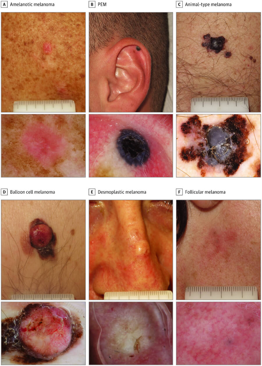 Cutaneous Melanoma