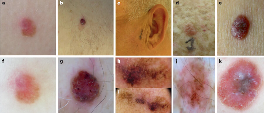 Cutaneous Melanoma