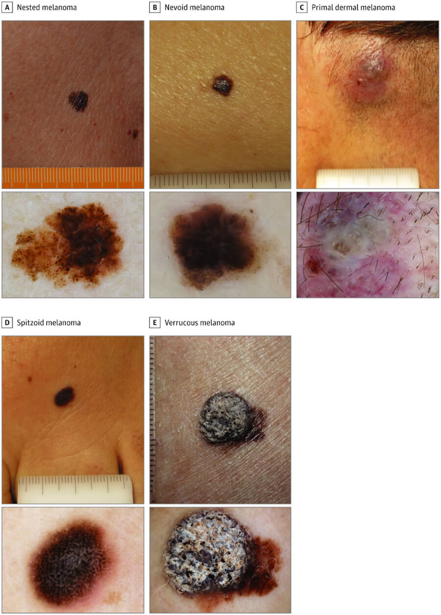 Cutaneous Melanoma