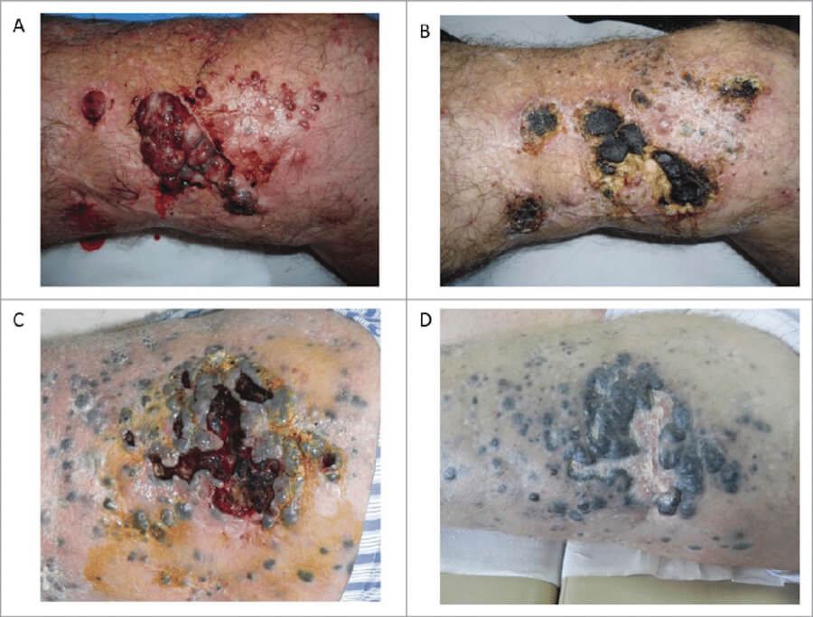 Cutaneous Melanoma