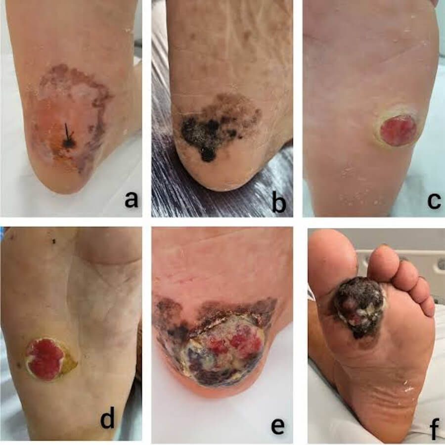 Cutaneous Melanoma