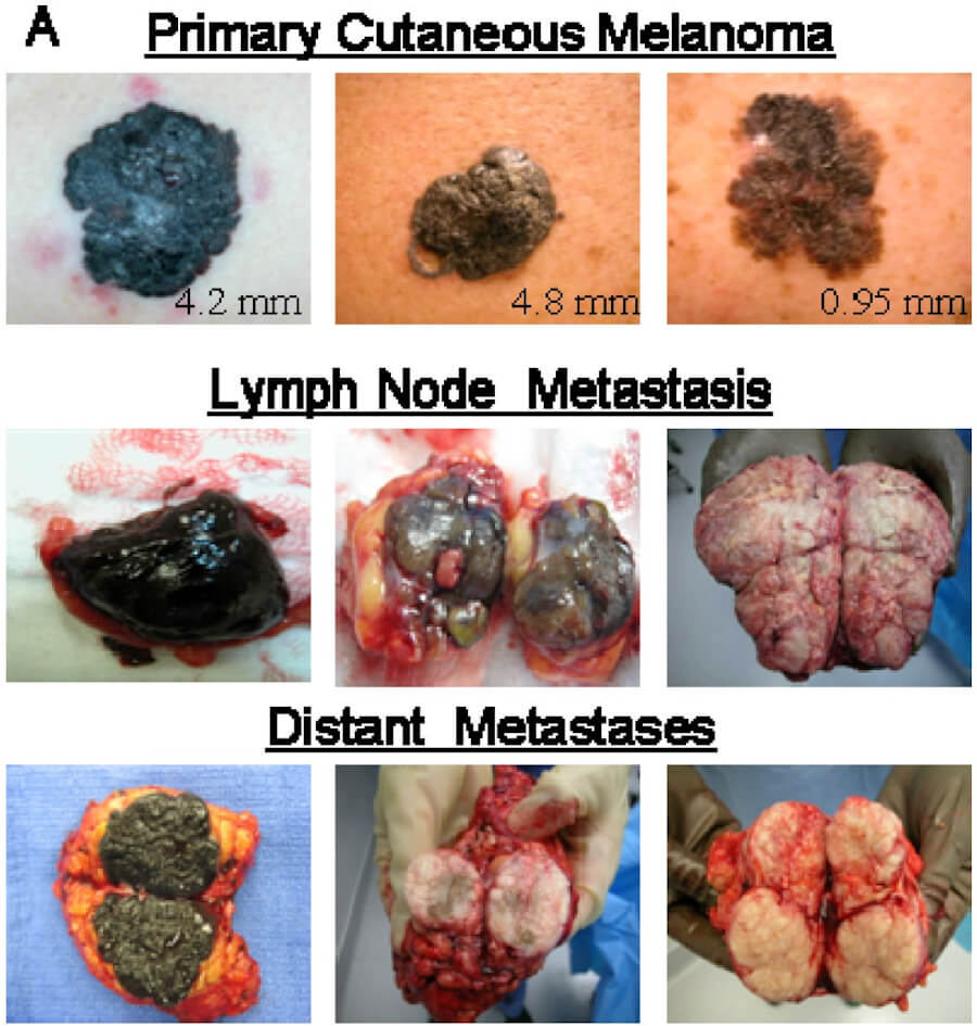 Cutaneous Melanoma
