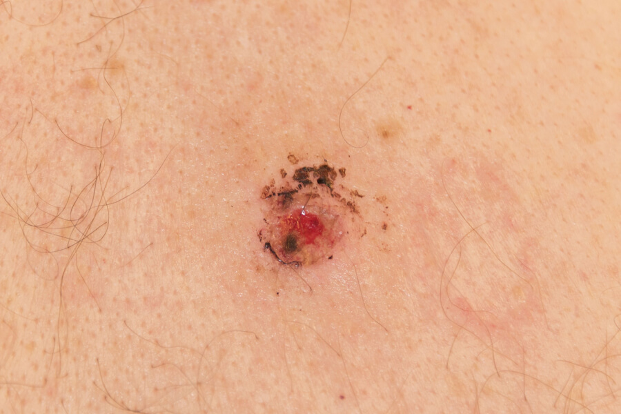 Cutaneous Melanoma