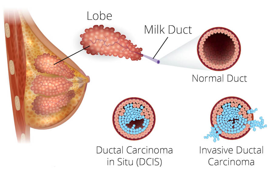 Ductal Carcinoma in situ DCIS