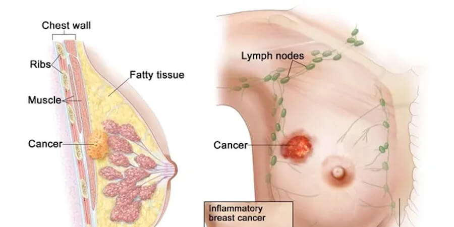 Inflammatory breast cancer
