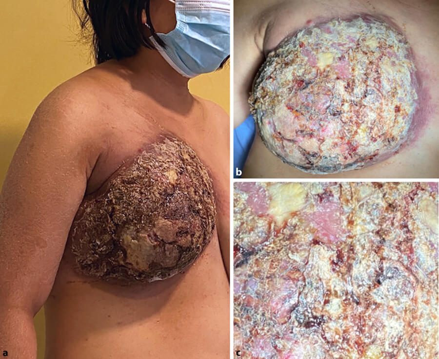 Inflammatory breast cancer IBC