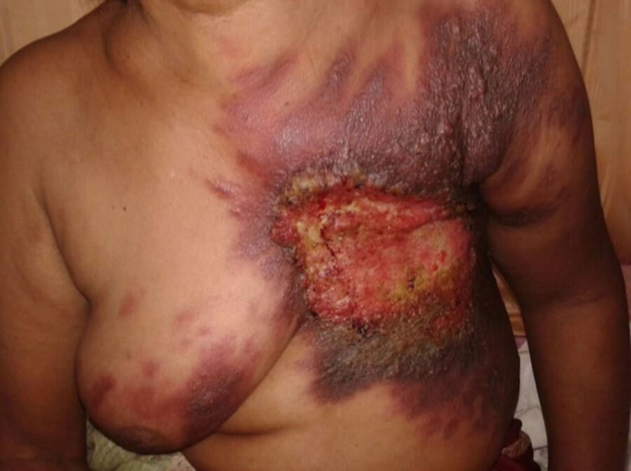 Inflammatory breast cancer IBC