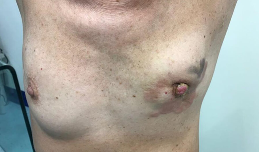 Inflammatory breast cancer IBC