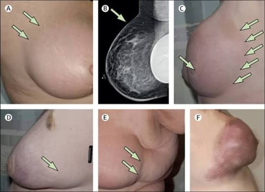 Inflammatory breast cancer IBC