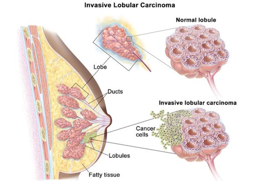 Invasive Lobular Carcinoma ILC