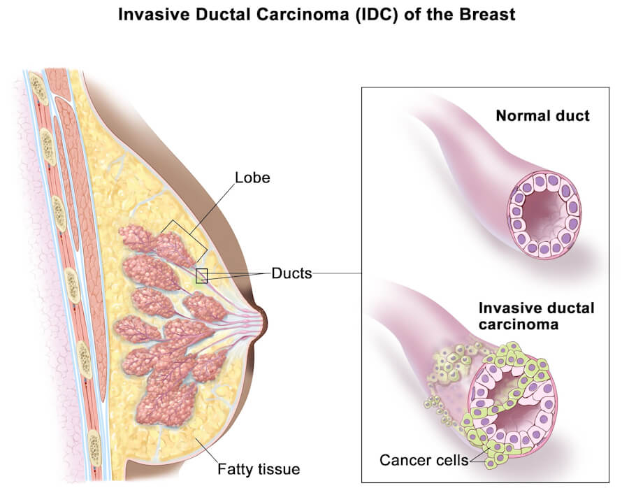 Invasive ductal carcinoma IDC