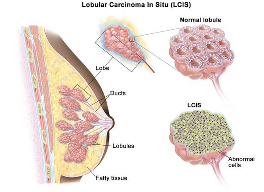 Lobular Carcinoma in situ LCIS