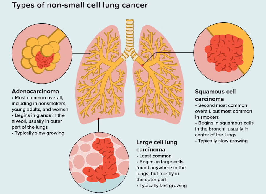 Non-small cell lung cancer (NSCLC)