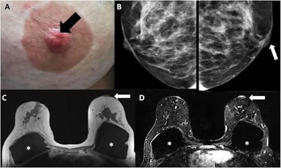 Paget disease of breast