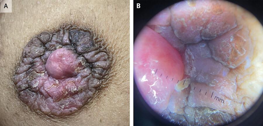 Paget disease of breast