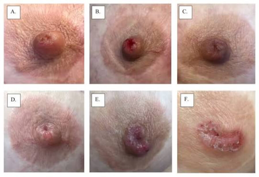 Paget disease of breast
