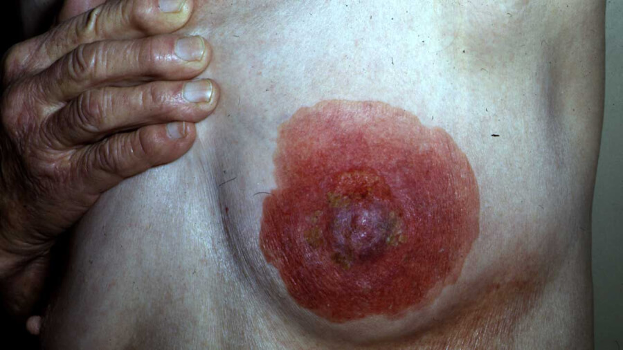 Paget disease of breast