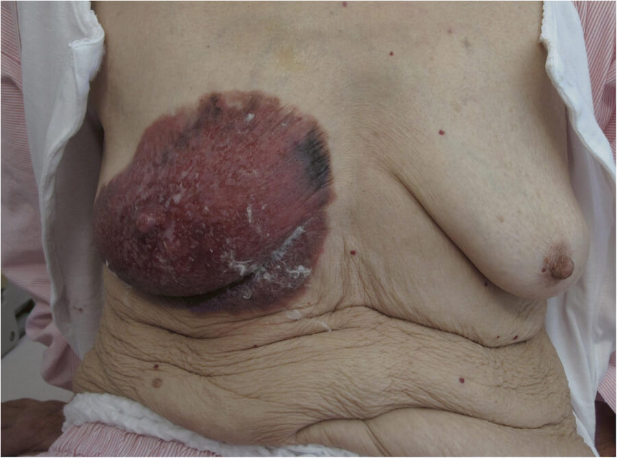 Paget disease of breast