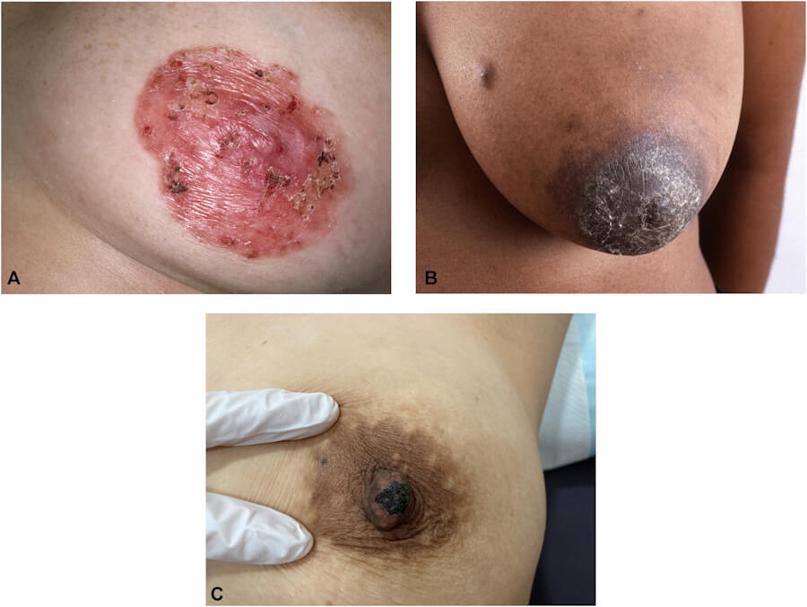 Paget disease of breast