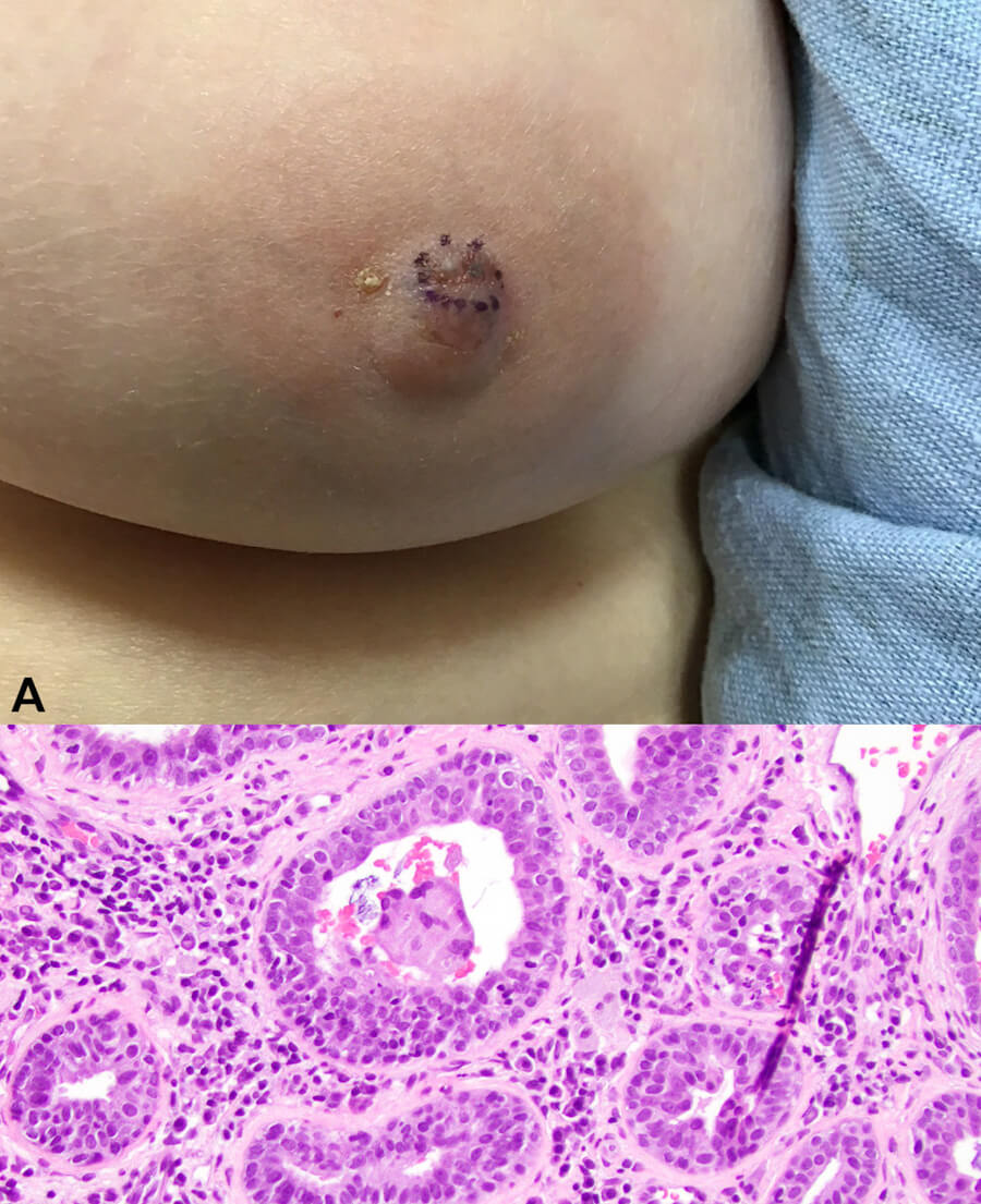Paget disease of breast