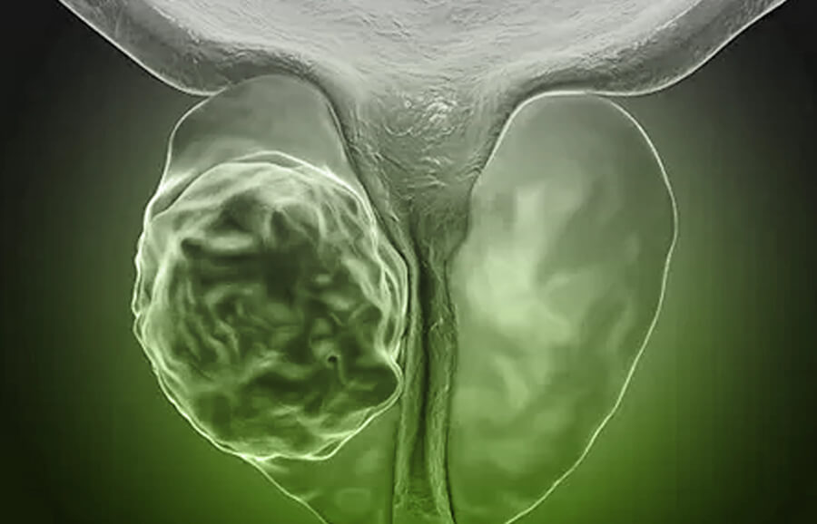 Prostate Adenocarcinoma