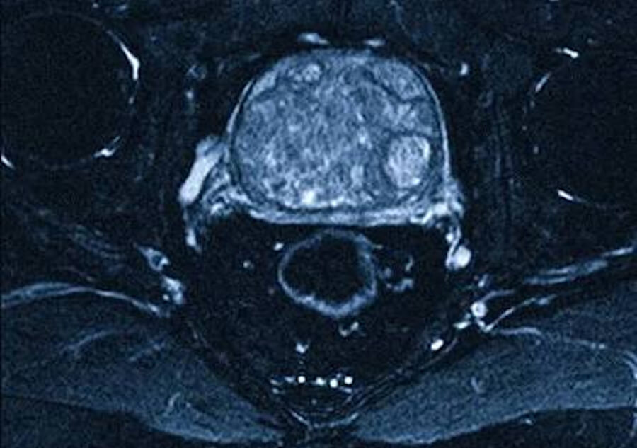 Prostate Adenocarcinoma, prostate cancer