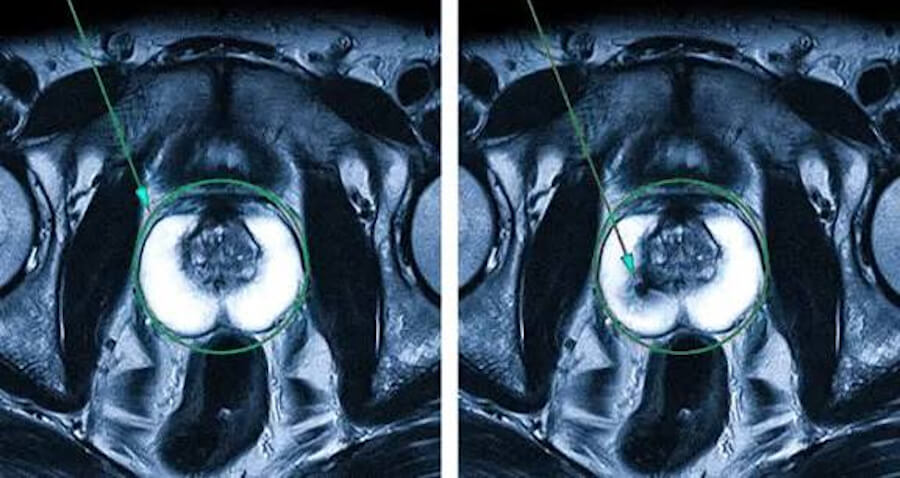 Prostate Adenocarcinoma, prostate cancer