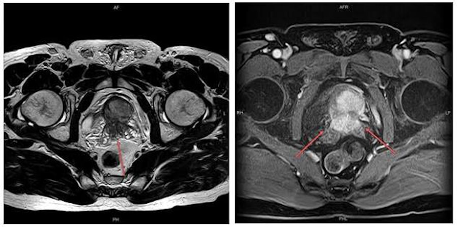 Prostate Adenocarcinoma, prostate cancer