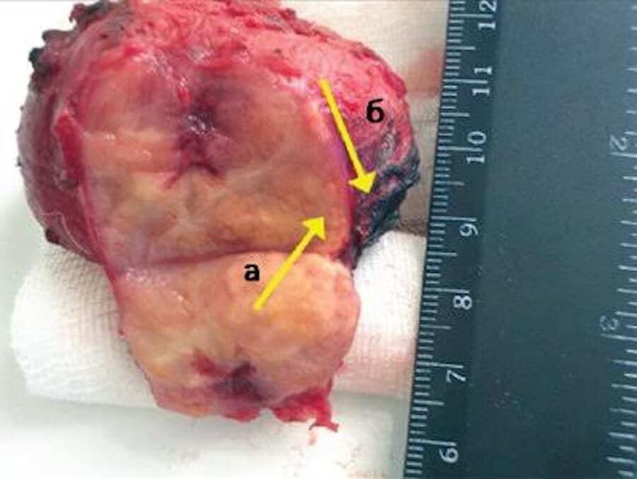 Prostate Adenocarcinoma, prostate cancer
