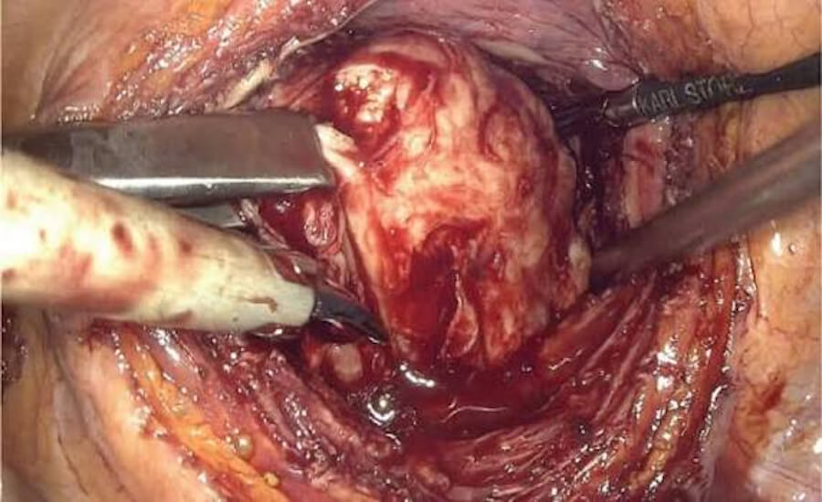 Prostate Adenocarcinoma, prostate cancer