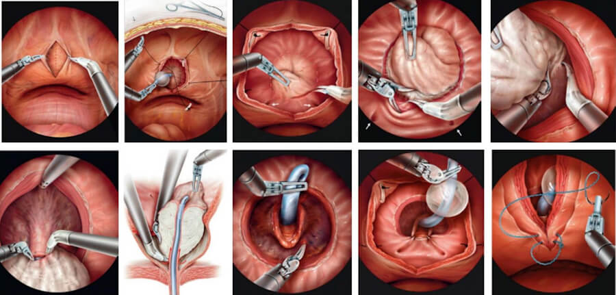 Prostate Adenocarcinoma, prostate cancer