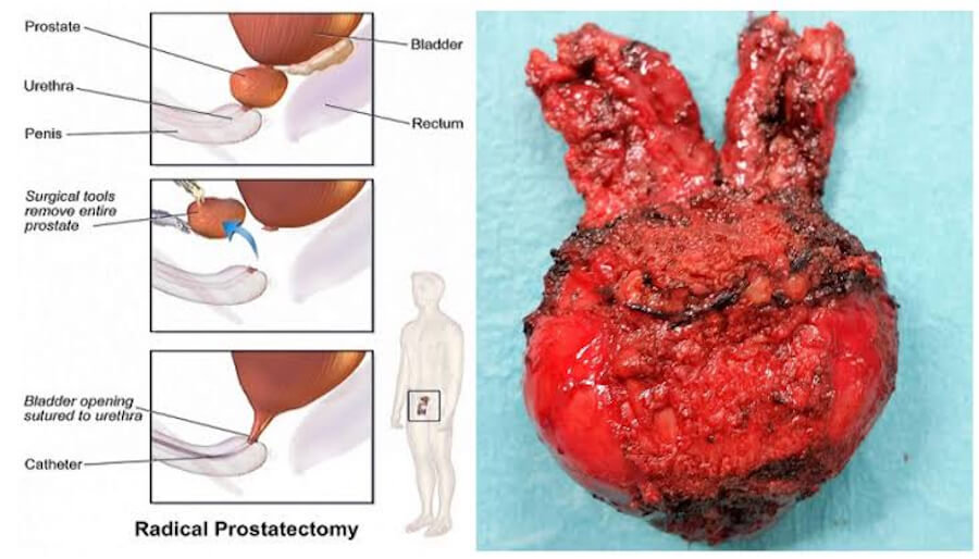 Prostate Adenocarcinoma, prostate cancer