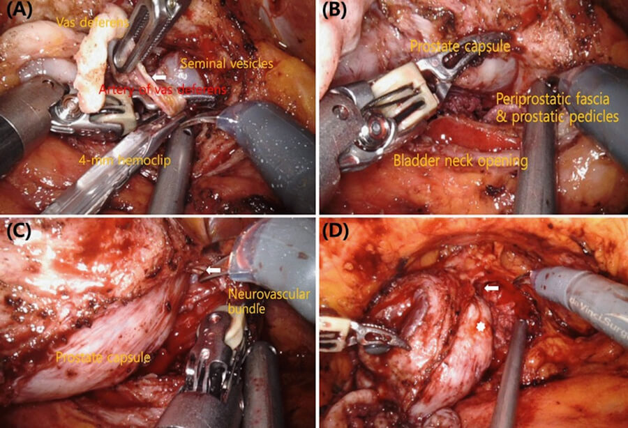 Prostate Adenocarcinoma, prostate cancer
