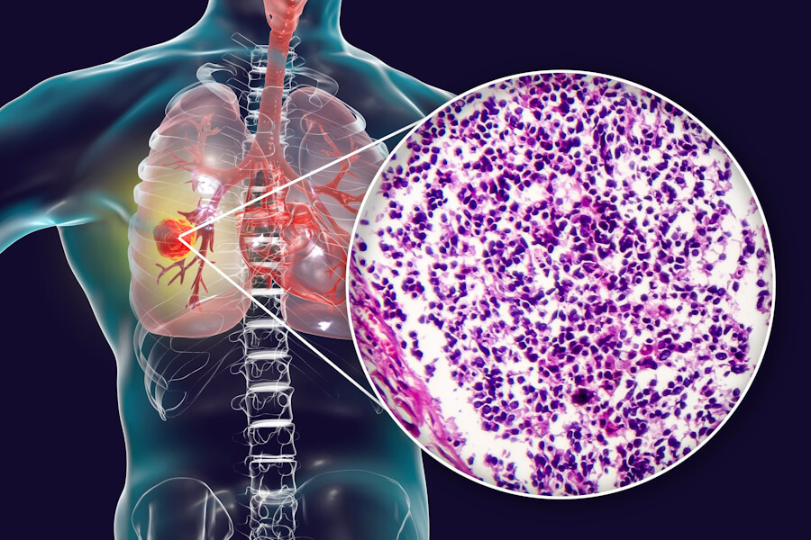 Small Cell Lung Cancer SCLC