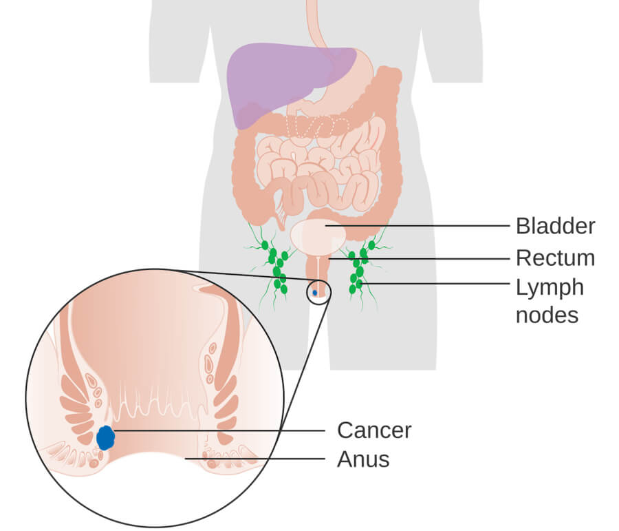 ANAL CANCER
