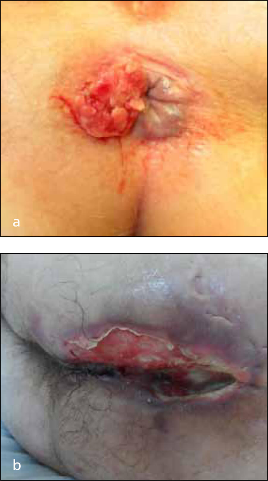 anal cancer