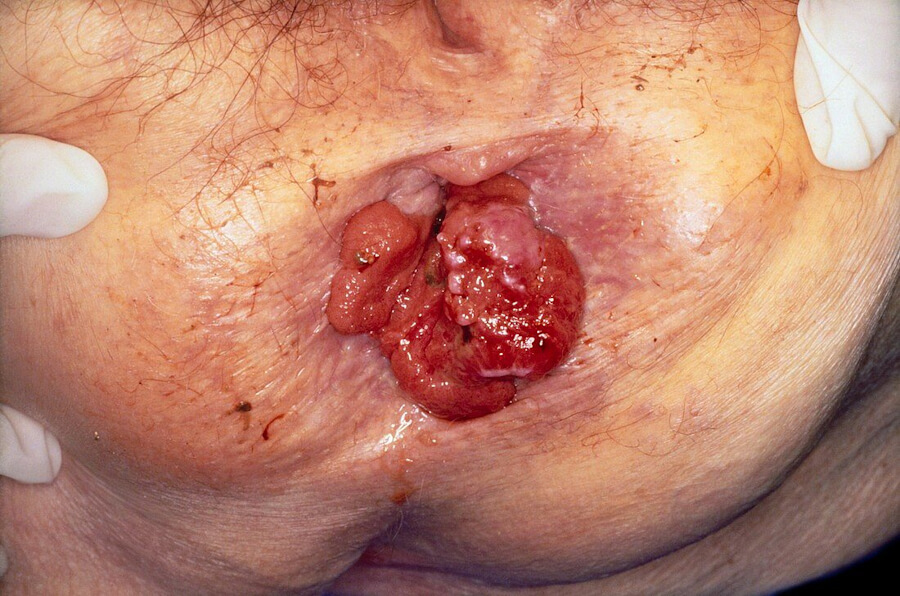 anal cancer
