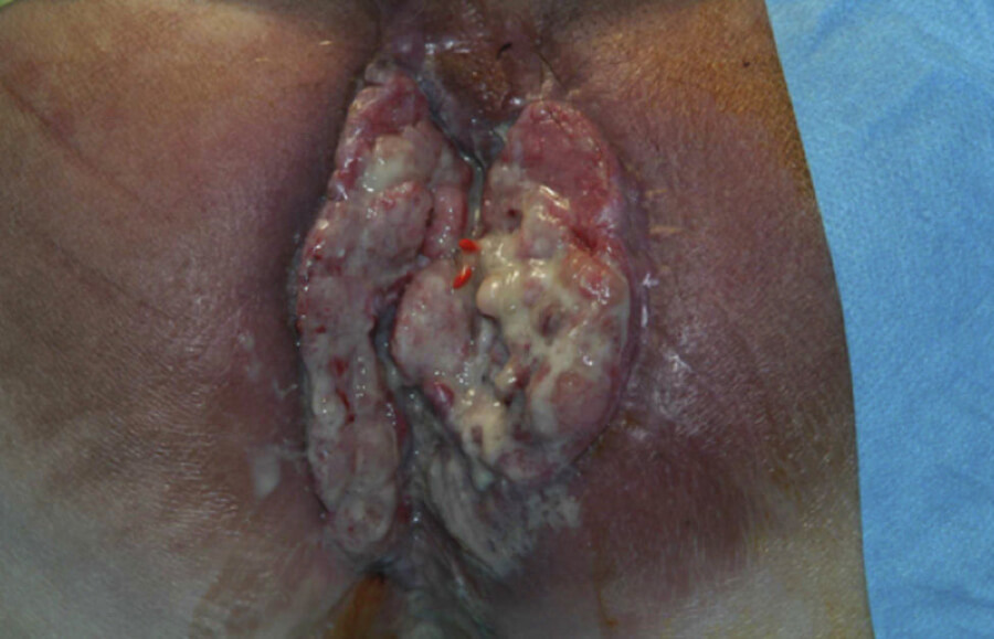 anal cancer