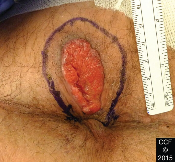 anal cancer
