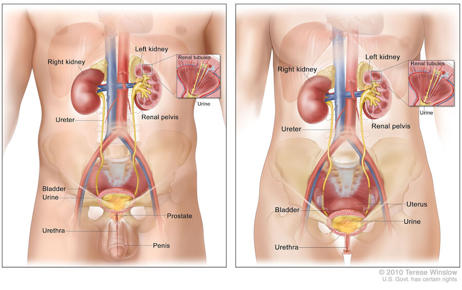 bladder cancer